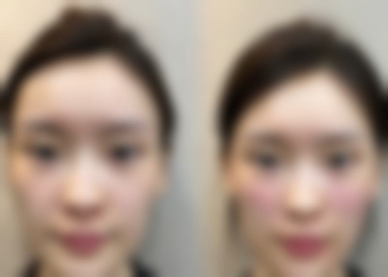 杭州天鑫医疗美容医院真实口碑实例，成效看得见