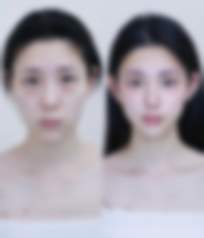 详解北京泰悦医疗“一人一策”方案与生物补片增粗术费用组成