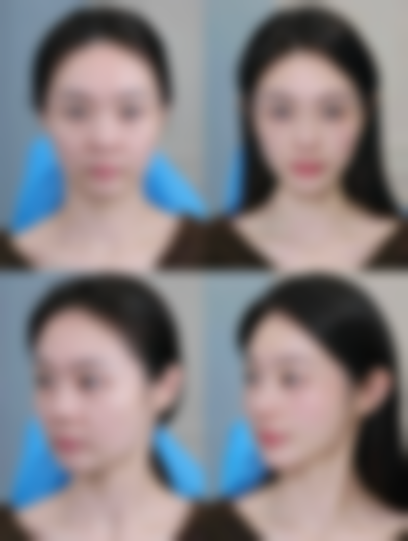 多眼皮修复成双眼皮的非手术妙招——按摩与双眼皮贴，你选对了吗？