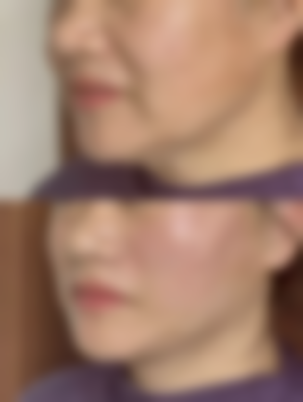 打保妥适除皱针有副作用吗？有！局部红肿、瘀斑、过敏是常见副作用要警惕；效果维持3 - 6个月，需定期注射别忽视 