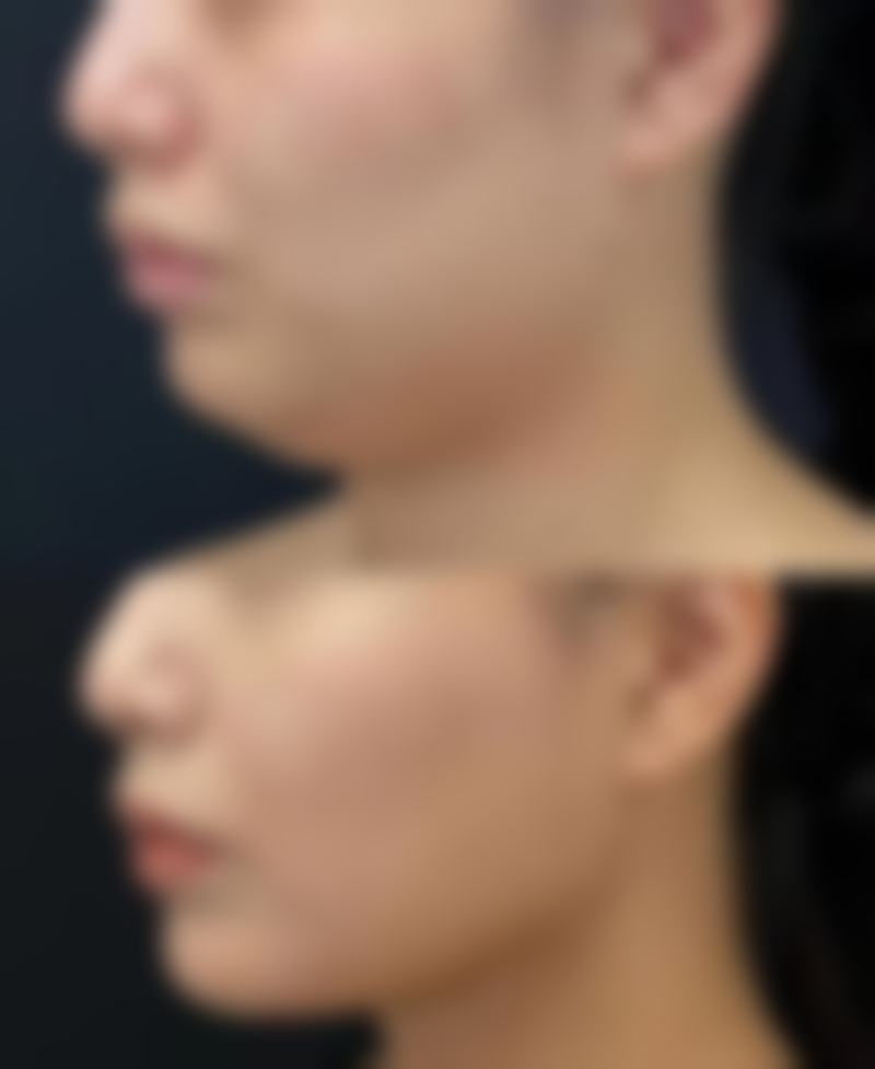 打保妥适除皱几天见效