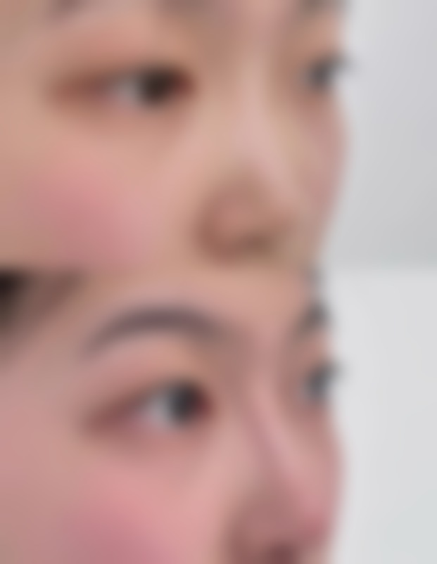 超肋隆鼻手术或治疗成效能维持多久？