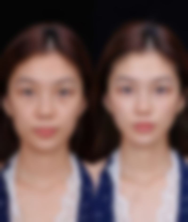 杭州天鑫招牌项目全解析：吸脂、眼鼻胸塑美各有绝活