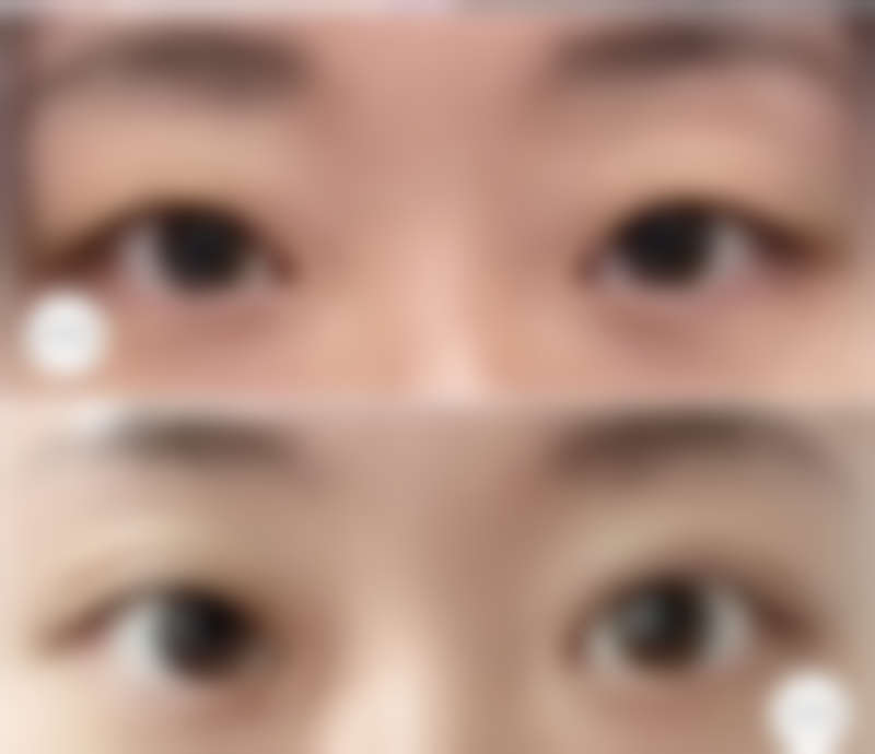 七、做了双眼皮怎么防止疤痕增生的费用为何差异明显？价格区间如何形成？