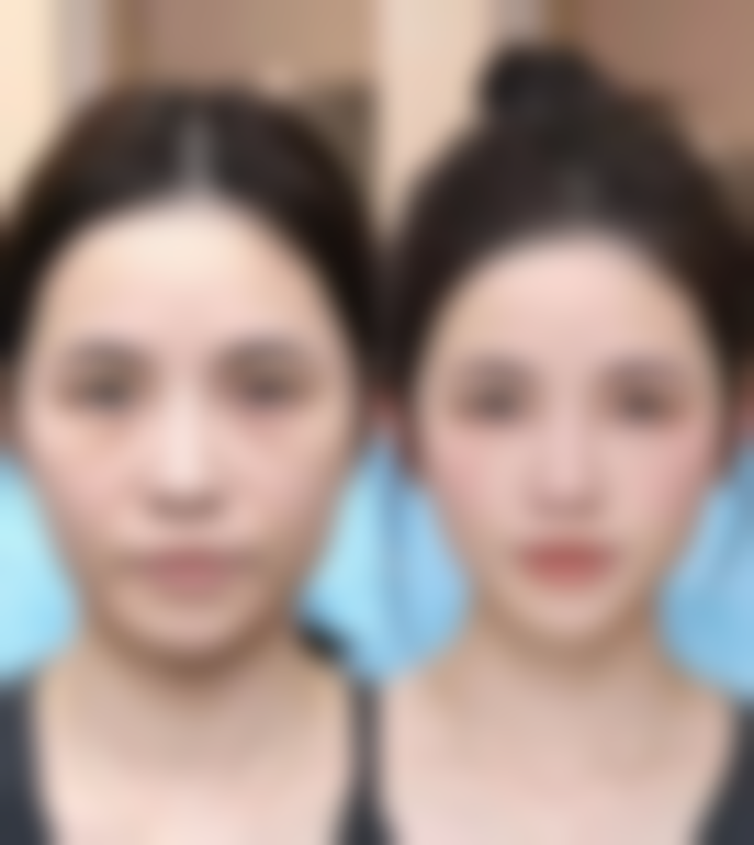 超肋隆鼻成效自然的原因