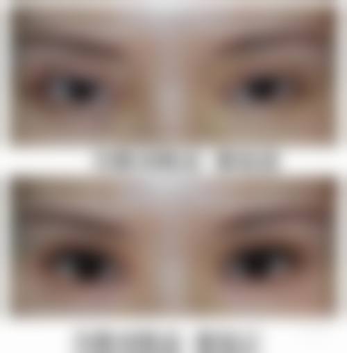 九、围绕疤痕体质适合的双眼皮手术,临床中更常见的并发问题有哪些?