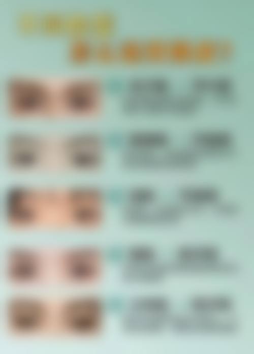 四、影响疤痕体质做双眼皮手术安心性的关键变量有哪些?