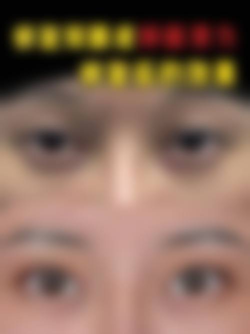 三等甲医院做去眼袋手术,医生经验多体现在哪些方面?