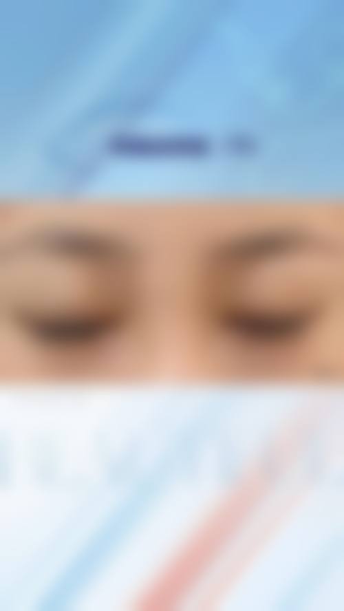 五、在实际操作中,疤痕体质适合的双眼皮手术更适合哪些人?