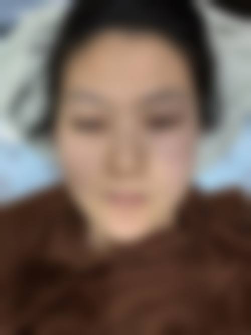 郑州地区热玛吉项目口碑实例3个