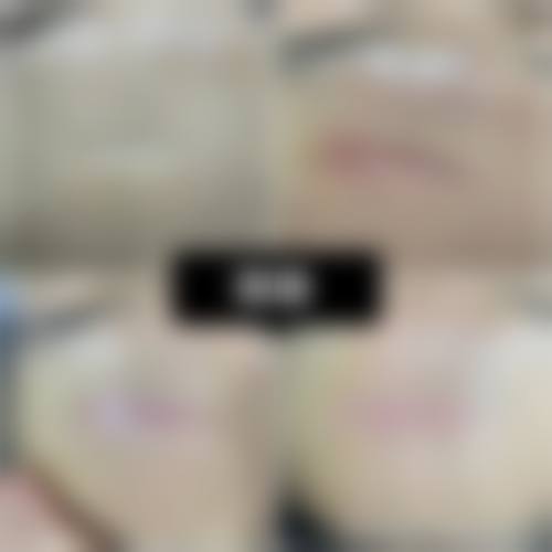 取出隆胸假体,一般需要多少钱?费用大剖析