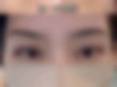 切开式双眼皮哪些人群适合,哪些情况不建议选择?