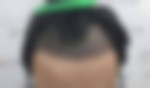 五、真实实例+口碑佐证，杭州连天美医疗美容医院变得更美成效看得见植发、脸型调整、皮肤项目等真人体验分享