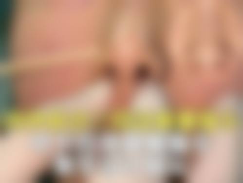 硅胶隆鼻常见并发症或后遗问题,在临床中如何理解其发生概率?