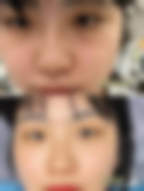 三等甲医院做去眼袋手术可以用医疗保险吗?