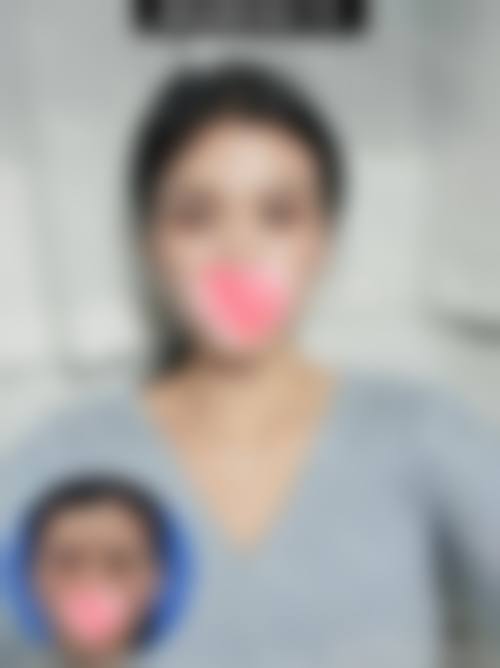 埋线式双眼皮价格区间及费用差异来源