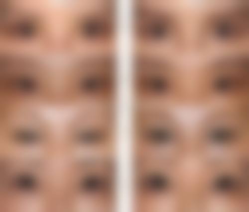 疾病引发的眼袋水肿该怎么治疗?