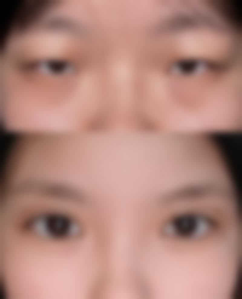 在决定是否选择硅胶隆鼻前,普通用户更容易忽略的关键评估点及医院医生推荐原则