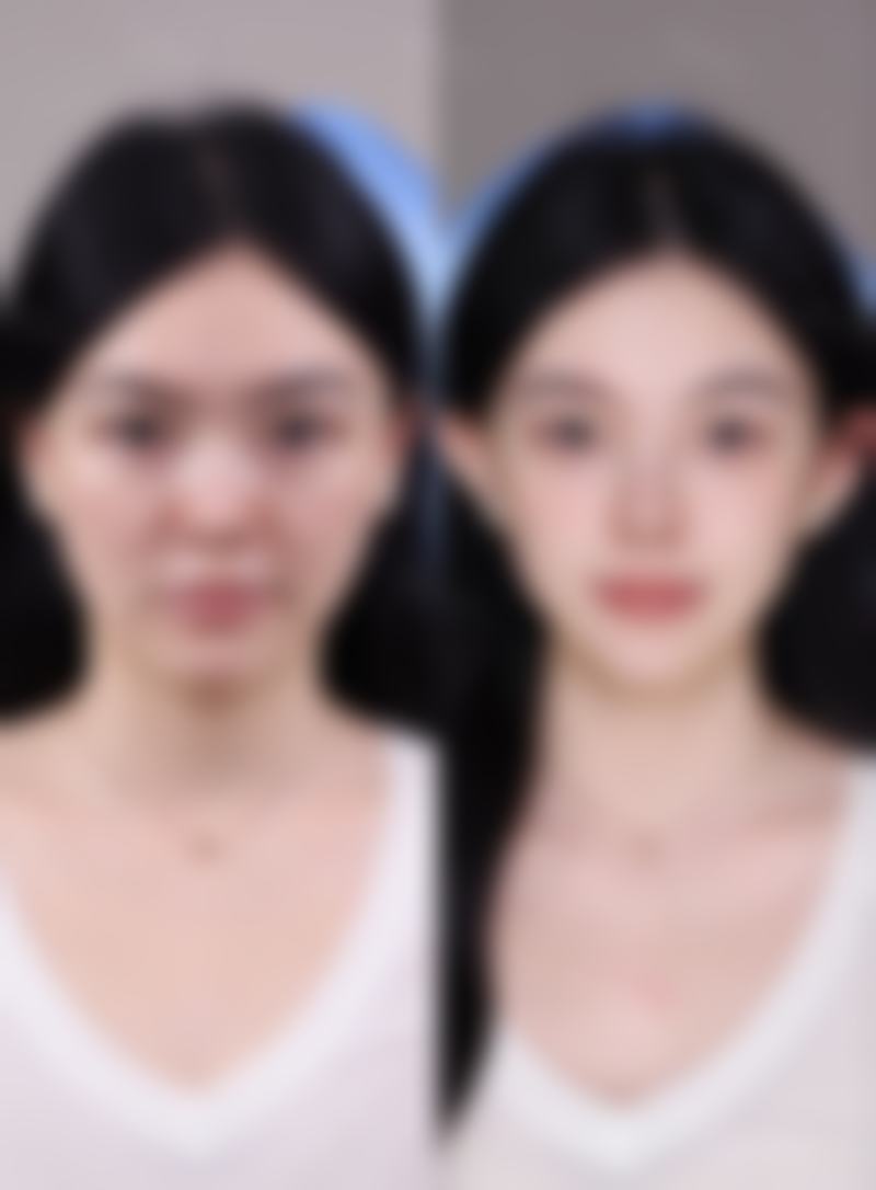 杭州地区爱拉丝提玻尿酸真实口碑实例