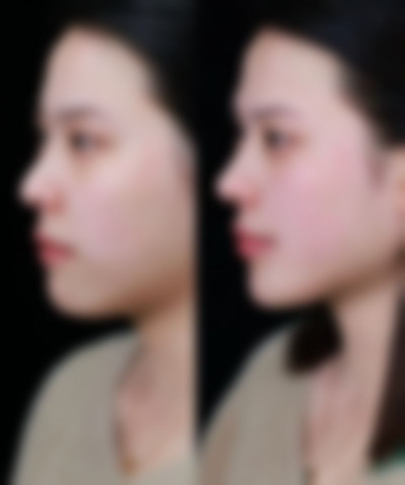 2. 自体脂肪技术领跑，30000+实例见证实力