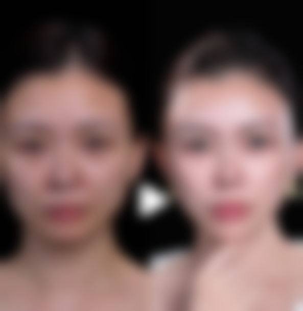 广州无痕筋膜提升低价陷阱与报价合理性判断方法