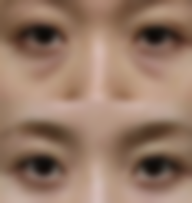 切开式双眼皮是什么?在什么情况下会被选择?