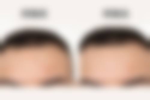 疤痕疙瘩治疗的风险与可控性