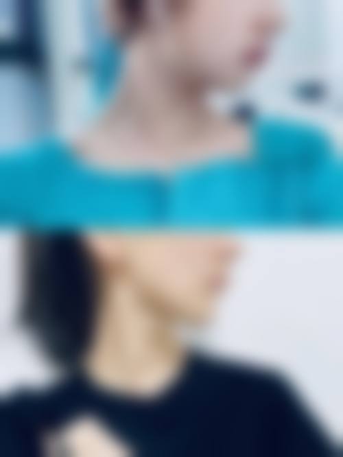 深圳富华隆鼻真实实例成效怎么样？从“塌鼻梁”到“立体颜”，真人反馈超真实！