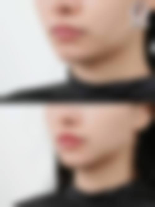 玻尿酸除皱效果如何？能快速填纹维持6 - 12个月，优势多、安全性高值得一试！ 