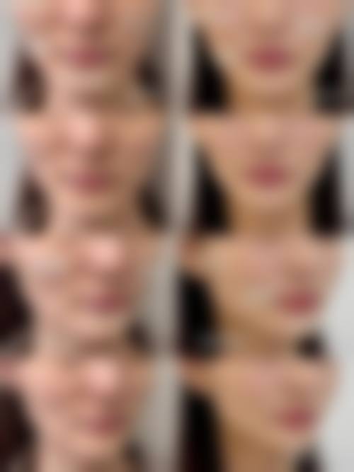 九、围绕玻尿酸除皱，临床中更常见的并发问题有哪些？