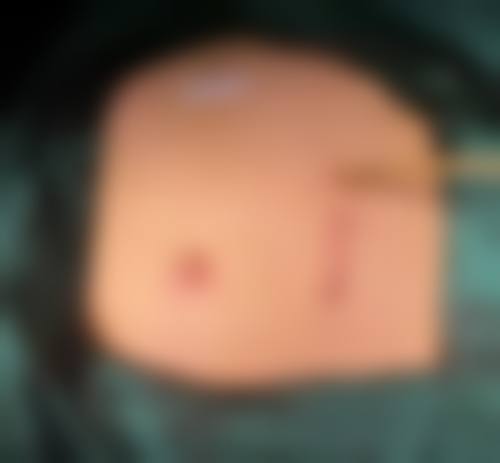 点痣后疤痕增生如何消除