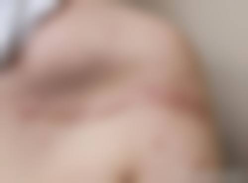 疤痕增生别发愁！药物、手术、激光疗法多管齐下，究竟如何有效应对？ 