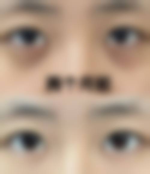 巧用眼霜按摩去除黑眼袋的原理