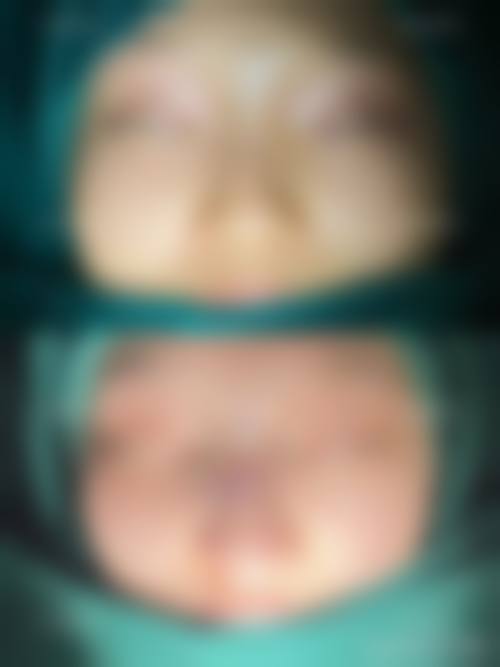 杭州地区假体隆鼻项目选择指南及避坑指南