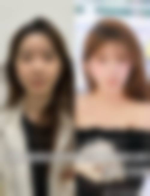 隆鼻假体可以恒久吗？