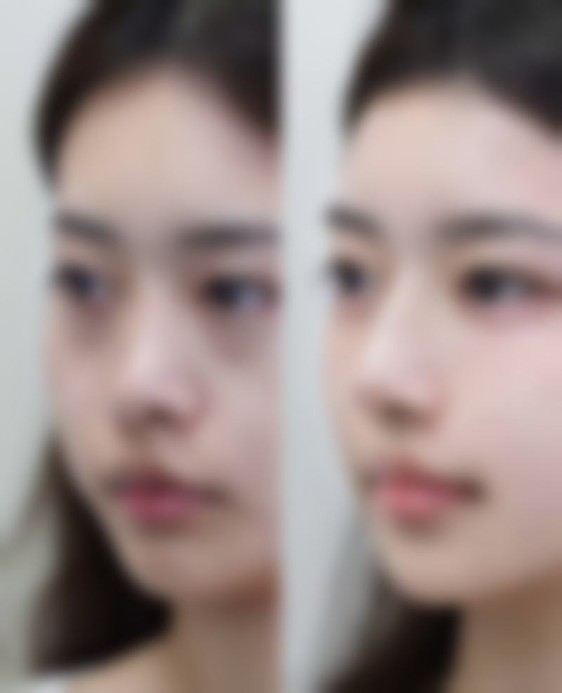 哪些人群在评估中更可能被建议考虑隆鼻假体？