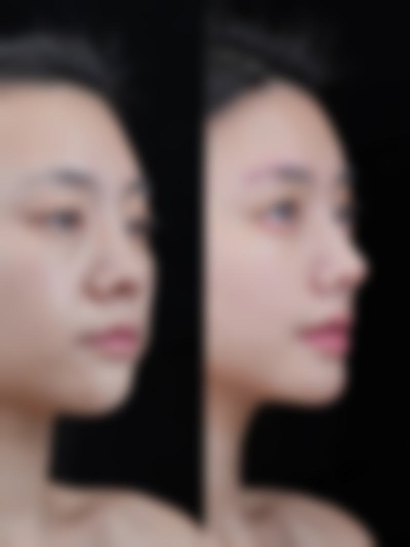 深圳富华医院的隆鼻技术有多牛？52°金字塔鼻综合技术让你美得自然又立体！