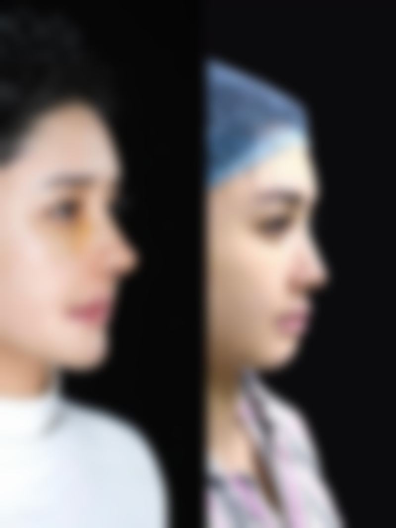 隆鼻假体的价格区间及费用差异来源