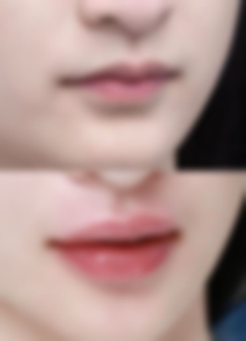 二、玻尿酸除皱通常在什么阶段被纳入医疗选择范围？