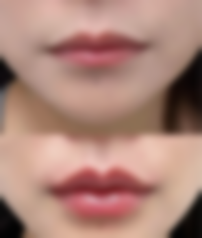 优雅人整形热门项目价格表：眼底脂肪重置等项目费用一目了然！