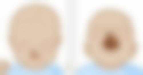 深圳不同地区玻尿酸填充额头价格