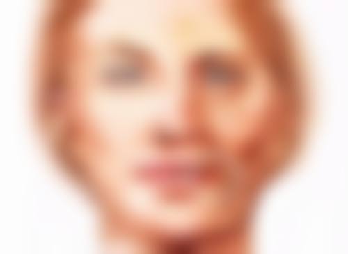 深圳不同品牌玻尿酸填充额头价格