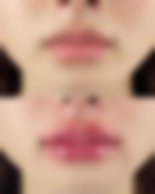 西安唇部整形排名第7名——西安美莱