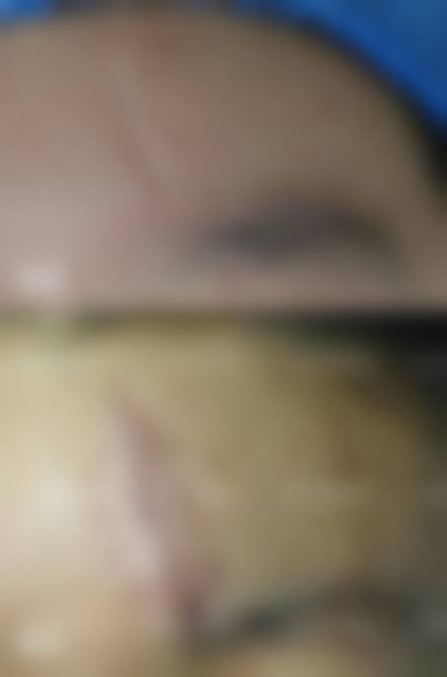 疤痕增生切除手术的技术优势体现在哪里