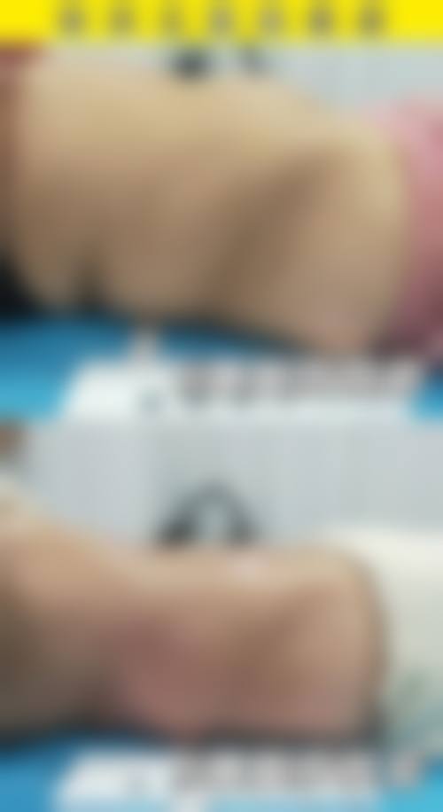 西安馒化脸修改价格表，收费标准是怎样的？价格贵不贵呀？2026年解答：吸脂塑形1.5万起、线雕提升2.8万起、玻尿酸溶解酶注射0.3万起