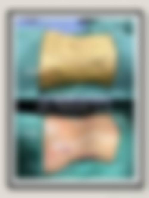 西安馒化脸玻尿酸溶解酶注射价格明细