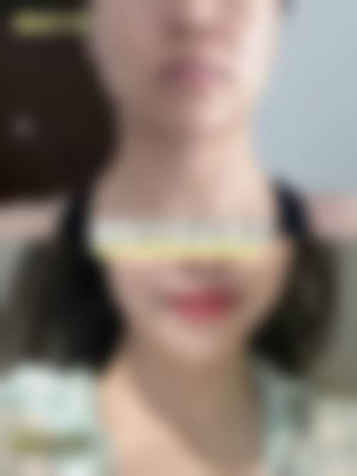 瘦脸针第一针多久见效？一般7 - 15天初见效果，1 - 3个月效果最佳，原因在这！首次打瘦脸针打几针合适，第一针和第二针间隔多久也有讲究！ 