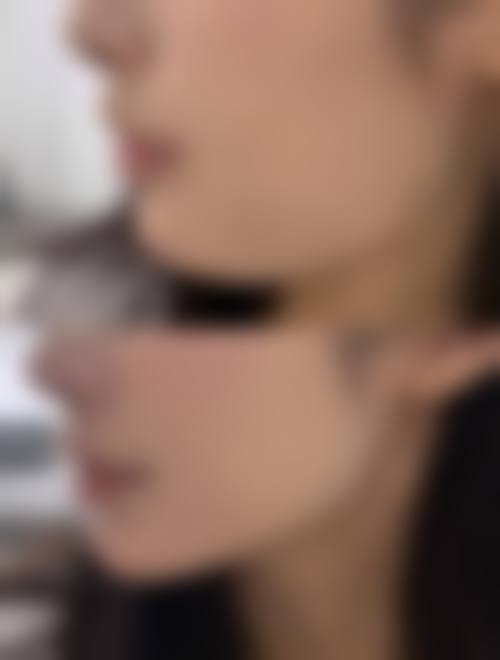 瘦脸针第一针何时见成效