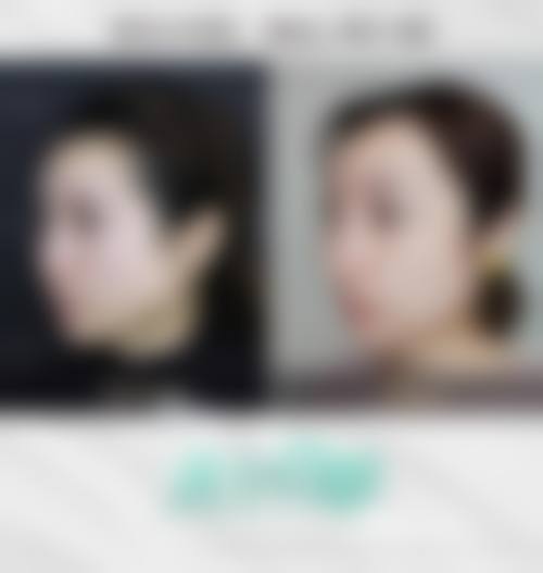 瘦脸针注射疗程次数怎么算？看完再也不迷茫