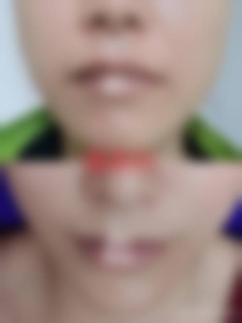 瘦脸针手术或治疗成效能维持多久？